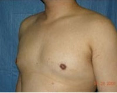 Male Breast Reduction Before & After Gallery - Patient 5951434 - Image 2