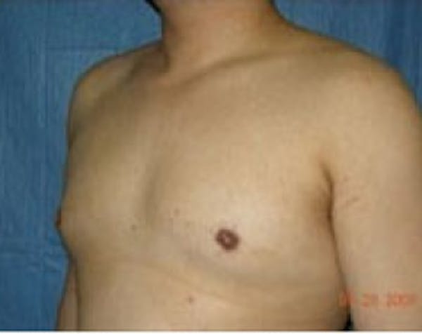 Male Breast Reduction Before & After Gallery - Patient 5951434 - Image 2