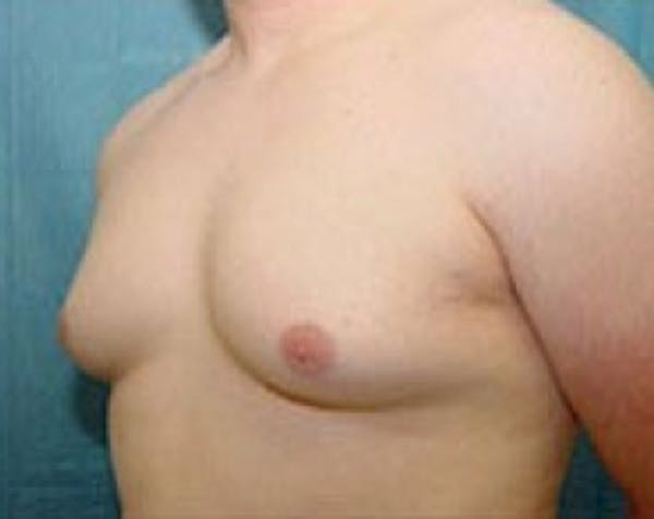Male Breast Reduction Gallery - Patient 5951436 - Image 1