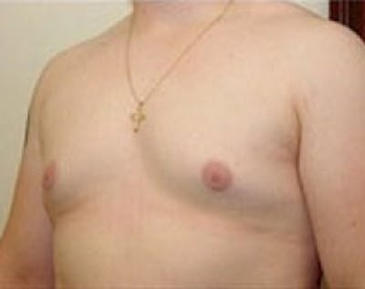 Male Breast Reduction Before & After Gallery - Patient 5951436 - Image 2