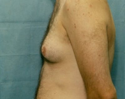 Male Breast Reduction Before & After Gallery - Patient 5951438 - Image 1