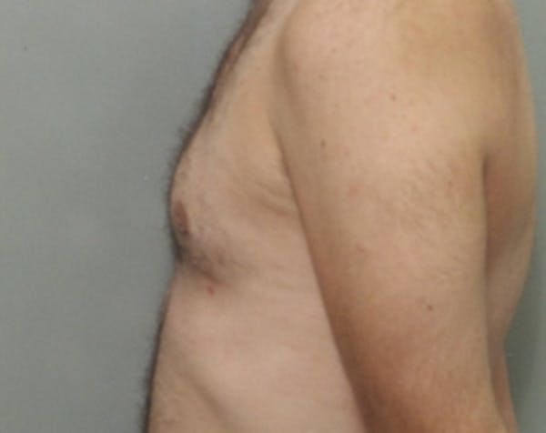 Male Breast Reduction Before & After Gallery - Patient 5951438 - Image 2