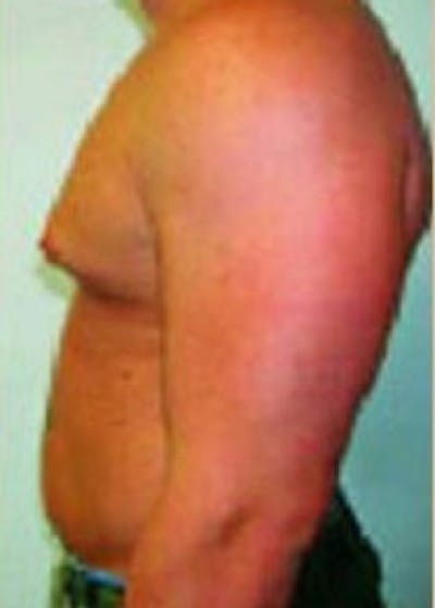 Male Breast Reduction Before & After Gallery - Patient 5951439 - Image 1