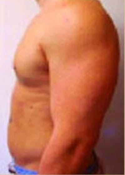 Male Breast Reduction Before & After Gallery - Patient 5951439 - Image 2