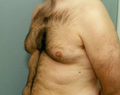 Male Breast Reduction Before & After Gallery - Patient 5951442 - Image 1