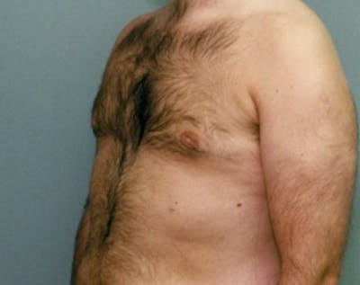 Male Breast Reduction Before & After Gallery - Patient 5951442 - Image 2