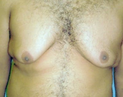 Male Breast Reduction Gallery - Patient 5951444 - Image 1