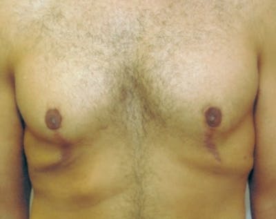 Male Breast Reduction Before & After Gallery - Patient 5951444 - Image 2