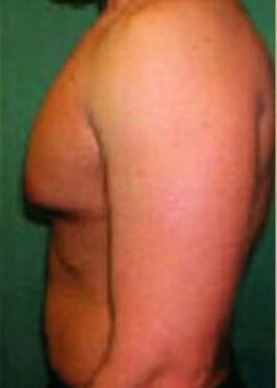 Male Breast Reduction Before & After Gallery - Patient 5951446 - Image 1