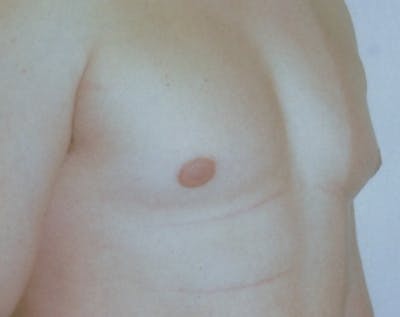 Male Breast Reduction Before & After Gallery - Patient 5951449 - Image 1