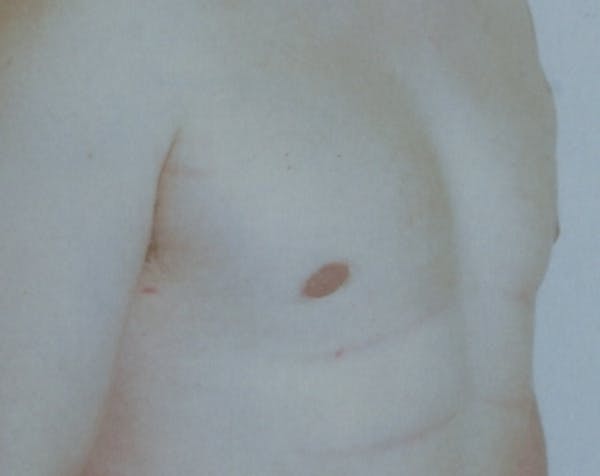 Male Breast Reduction Before & After Gallery - Patient 5951449 - Image 2