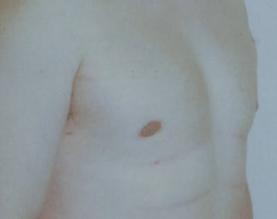 Male Breast Reduction Before & After Gallery - Patient 5951449 - Image 2
