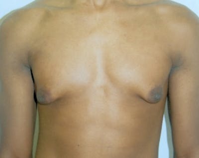 Male Breast Reduction Before & After Gallery - Patient 5951452 - Image 1