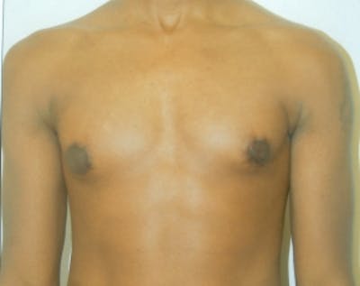 Male Breast Reduction Before & After Gallery - Patient 5951452 - Image 2