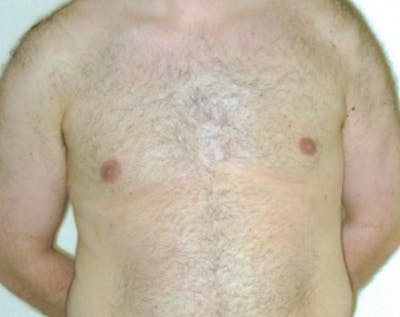 Male Breast Reduction Before & After Gallery - Patient 5951454 - Image 2