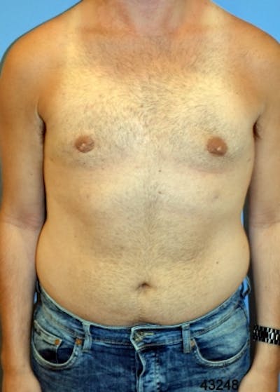 Male Breast Reduction Before & After Gallery - Patient 5951671 - Image 2