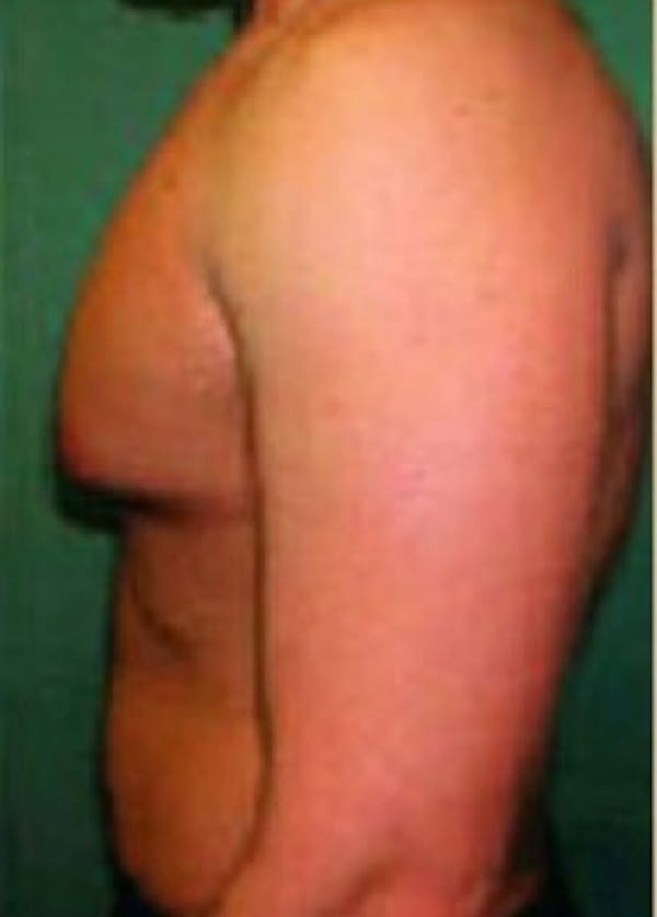 Male Breast Reduction Before & After Gallery - Patient 5951677 - Image 1