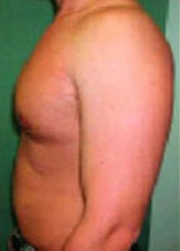 Male Breast Reduction Before & After Gallery - Patient 5951677 - Image 2