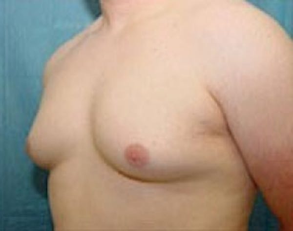 Male Breast Reduction Gallery - Patient 5951678 - Image 1