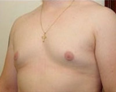 Male Breast Reduction Before & After Gallery - Patient 5951678 - Image 2