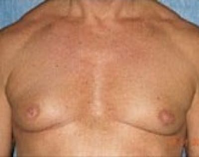 Male Breast Reduction Before & After Gallery - Patient 5951679 - Image 1