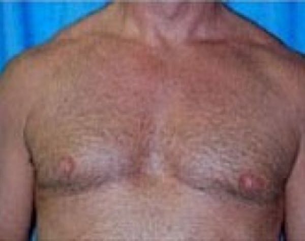 Male Breast Reduction Before & After Gallery - Patient 5951679 - Image 2