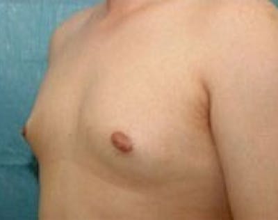 Male Breast Reduction Before & After Gallery - Patient 5951680 - Image 1