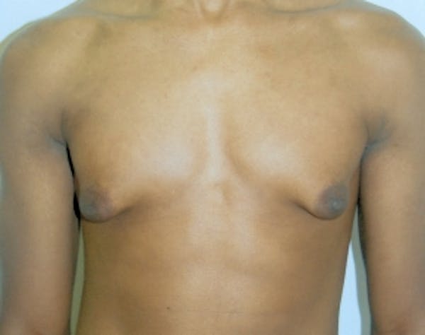 Male Breast Reduction Before & After Gallery - Patient 5951686 - Image 1