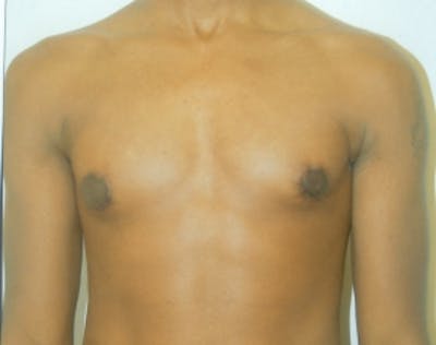 Male Breast Reduction Before & After Gallery - Patient 5951686 - Image 2