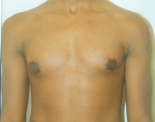 Male Breast Reduction Gallery - Patient 5951686 - Image 2