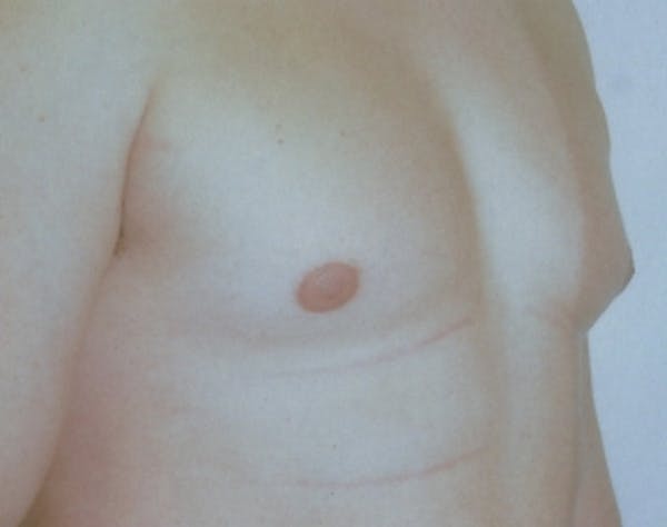 Male Breast Reduction Before & After Gallery - Patient 5951688 - Image 1