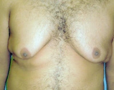 Male Breast Reduction Before & After Gallery - Patient 5951691 - Image 1