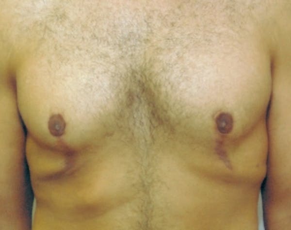 Male Breast Reduction Gallery - Patient 5951691 - Image 2