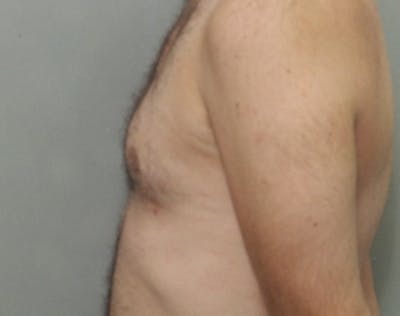 Male Breast Reduction Before & After Gallery - Patient 5951694 - Image 2