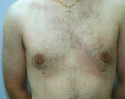 Male Breast Reduction Before & After Gallery - Patient 5951696 - Image 2