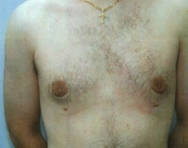 Male Breast Reduction Before & After Gallery - Patient 5951696 - Image 2