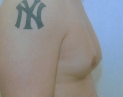 Male Breast Reduction Before & After Gallery - Patient 5951698 - Image 1