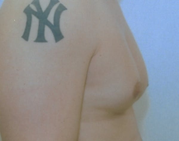 Male Breast Reduction Gallery - Patient 5951698 - Image 1