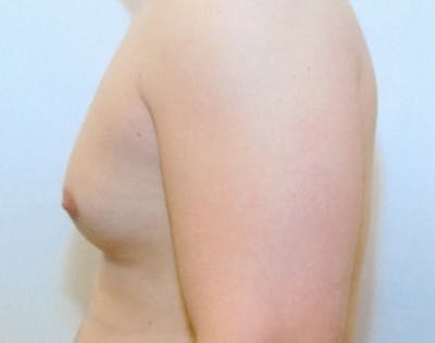 Male Breast Reduction Before & After Gallery - Patient 5951702 - Image 1