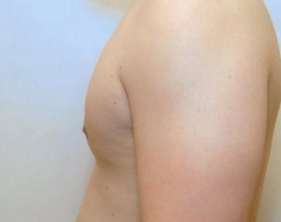 Male Breast Reduction Before & After Gallery - Patient 5951702 - Image 2