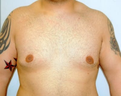 Male Breast Reduction Before & After Gallery - Patient 5951704 - Image 2