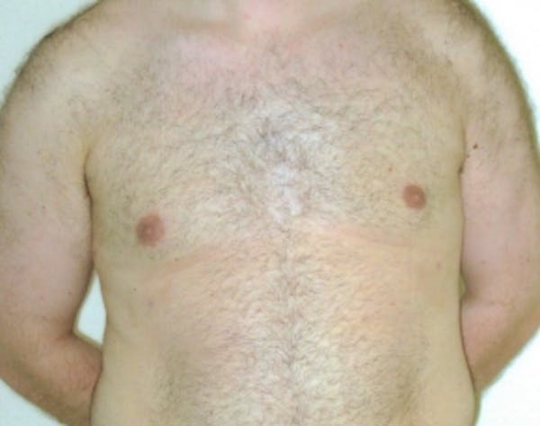 Male Breast Reduction Before & After Gallery - Patient 5951707 - Image 2