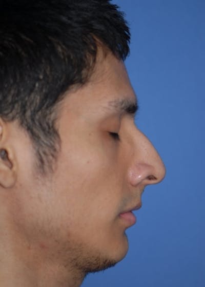 Rhinoplasty Before & After Gallery - Patient 5952002 - Image 1