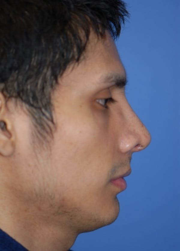 Rhinoplasty Before & After Gallery - Patient 5952002 - Image 2