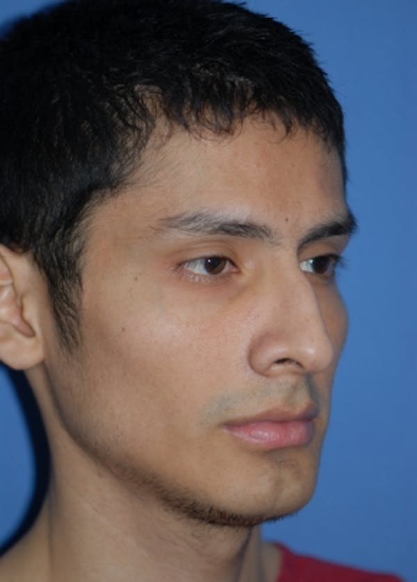 Rhinoplasty Before & After Gallery - Patient 5952002 - Image 3