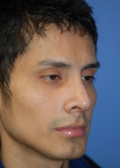 Rhinoplasty Before & After Gallery - Patient 5952002 - Image 4
