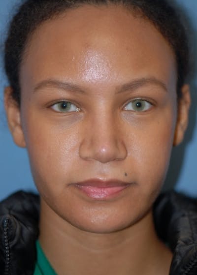 Rhinoplasty Before & After Gallery - Patient 5952152 - Image 2