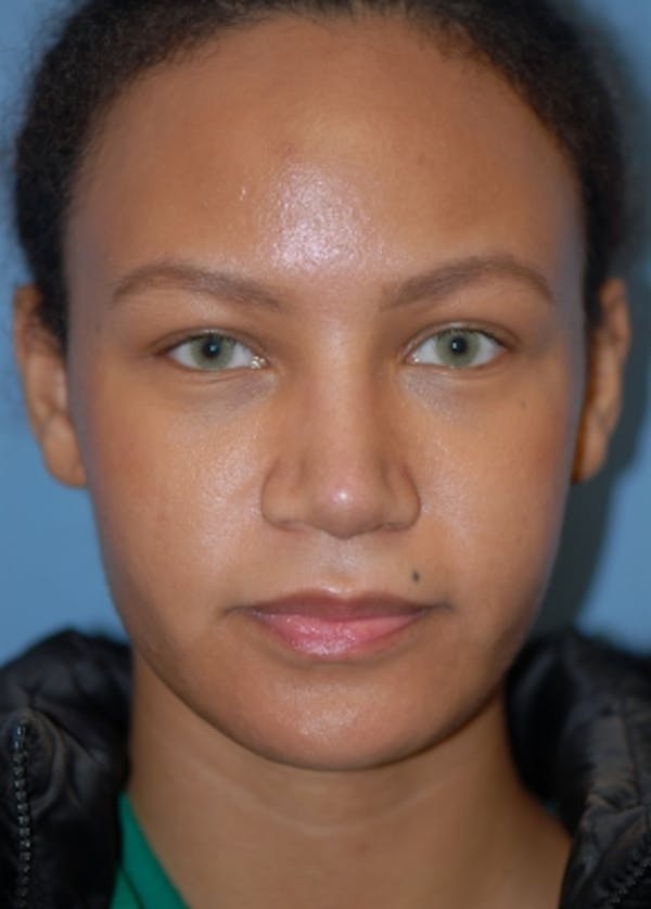 Rhinoplasty Before & After Gallery - Patient 5952152 - Image 2
