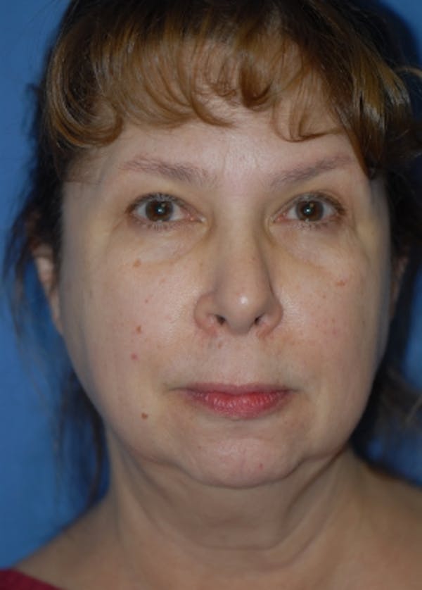 Facelift and Mini Facelift Gallery - Patient 5952109 - Image 1