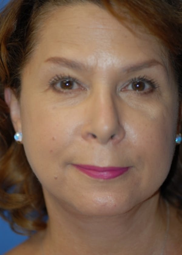 Facelift and Mini Facelift Before & After Gallery - Patient 5952109 - Image 2